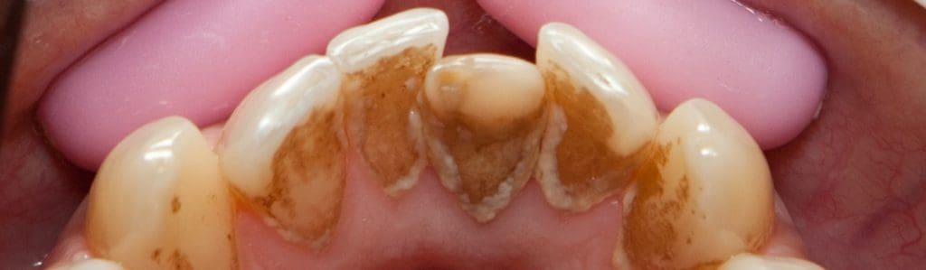 Tooth with tartar (Calculus) and plaque
