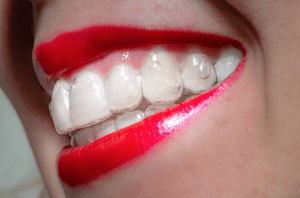 Invisalign aligners fitted with the attachments present