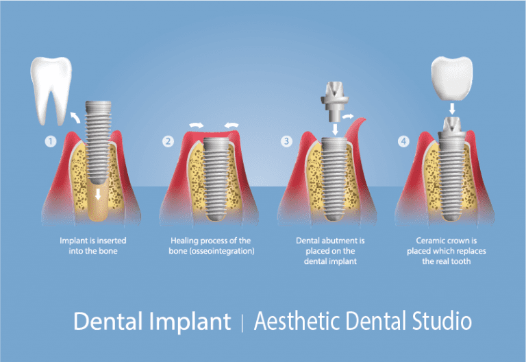 Infographic for a placement of a single implant supported crown